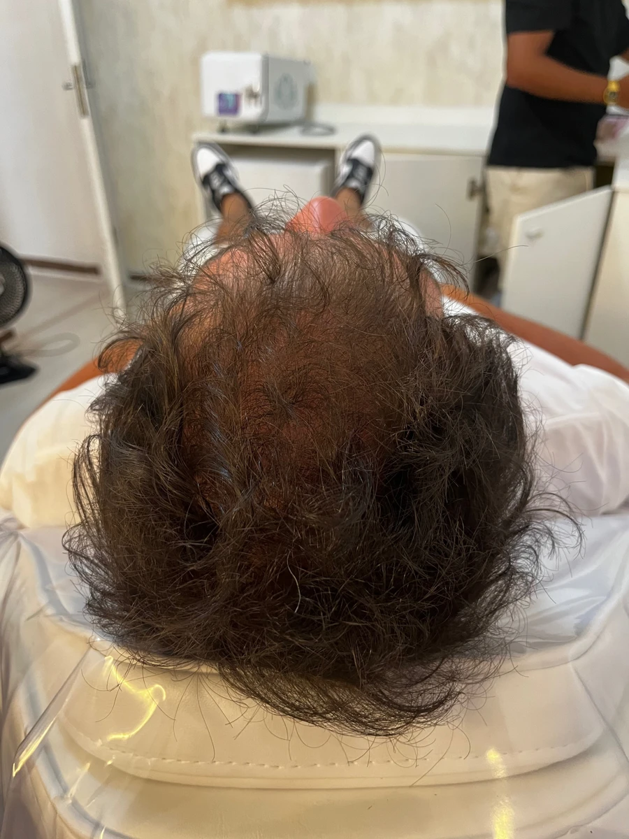 Foto do catálogo da clínica: Terapia Capilar Avançada