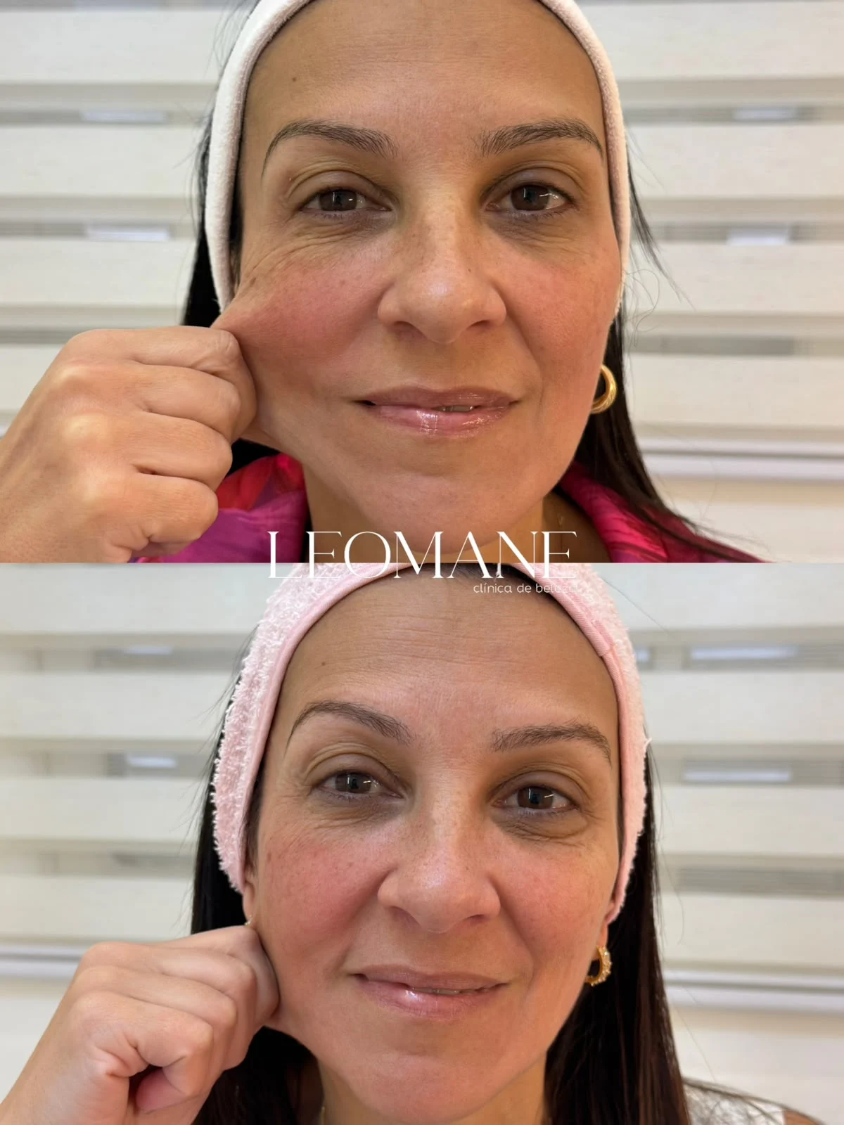 Imagem do catálogo: Bioestimulador de colágeno facial