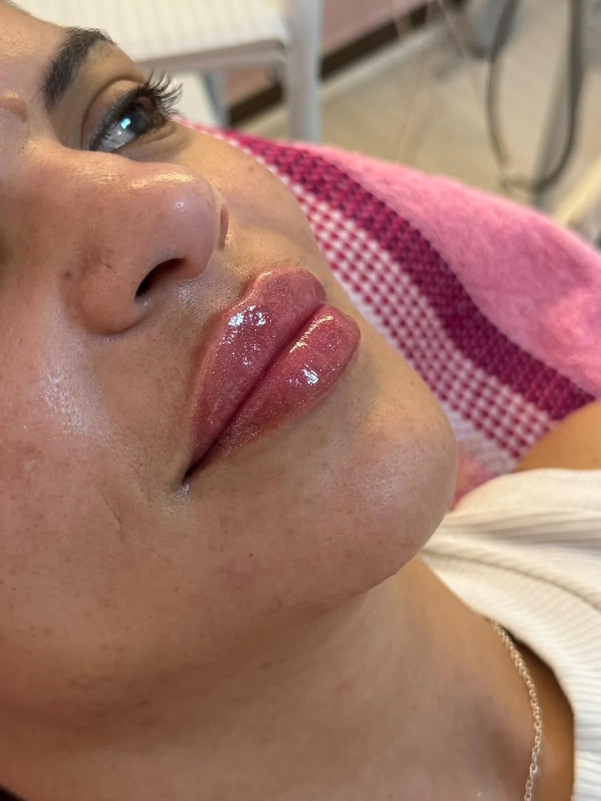 Imagem do catálogo: Preenchimento labial