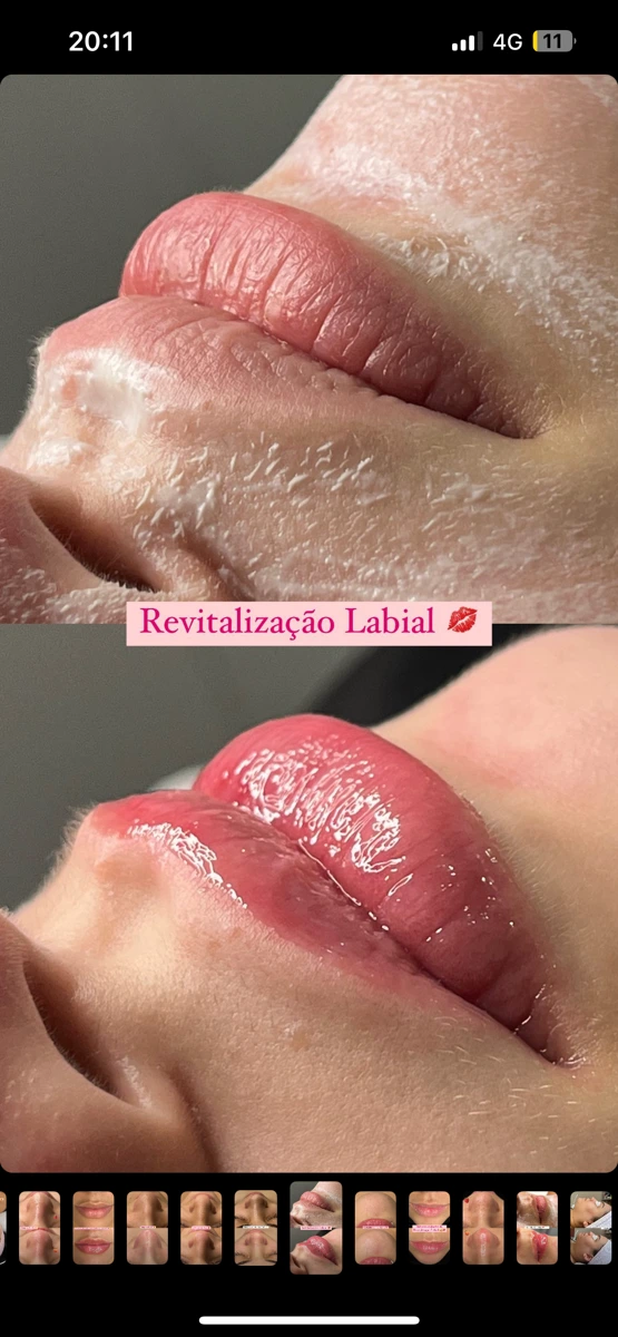 Imagem do catálogo: Revitalização labial